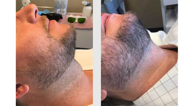 Laser hair removal neck
