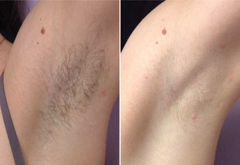 Laser hair removal under arm