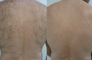 Laser hair removal back
