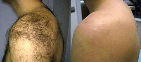 Laser hair removal shoulders