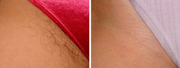 Laser hair removal pubic area