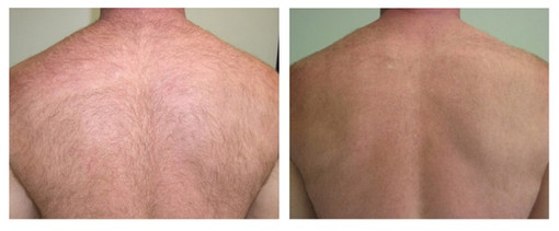 Laser hair removal back