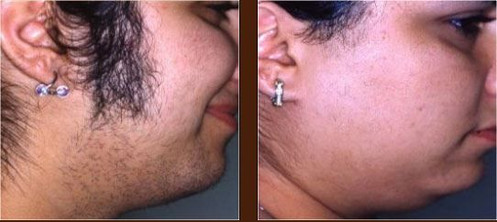 Laser hair removal chin