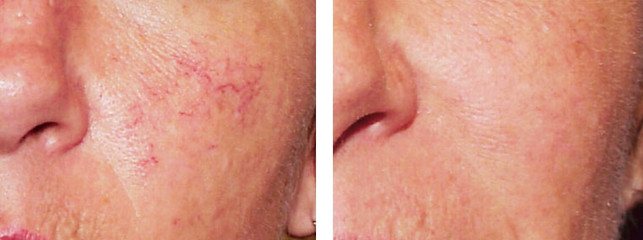 Laser spider vein removal results