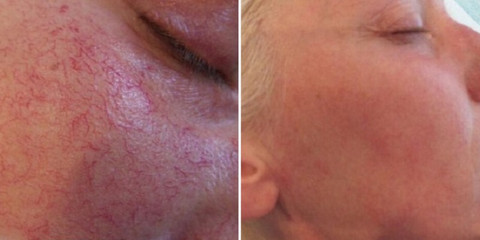 Laser spider vein removal results