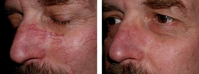 Laser spider vein removal results