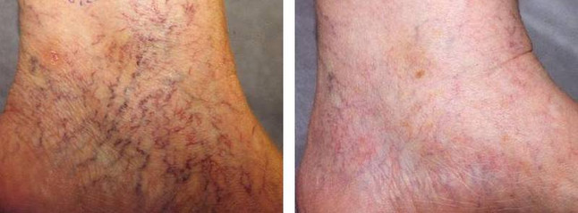 Laser spider vein removal results