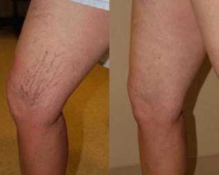 Laser spider vein removal results