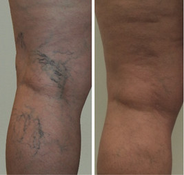 Laser spider vein removal results