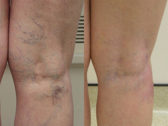 Laser spider vein removal results