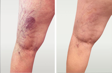 Laser spider vein removal results