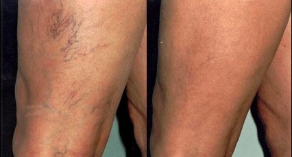 Laser spider vein removal results