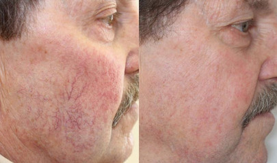 Laser spider vein removal results