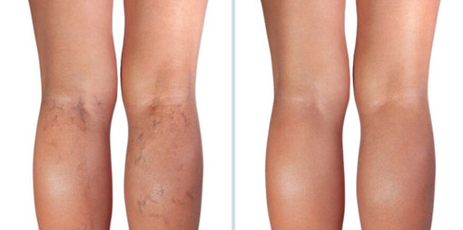Laser spider vein removal results