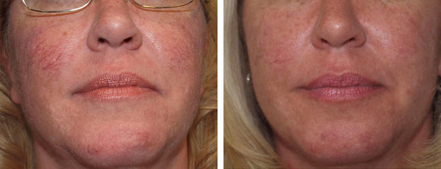 Laser spider vein removal results