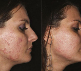 Laser stretchmark scar removal in woman