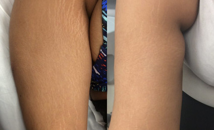 Laser stretchmark scar removal in woman