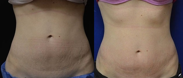 Laser stretchmark scar removal in woman