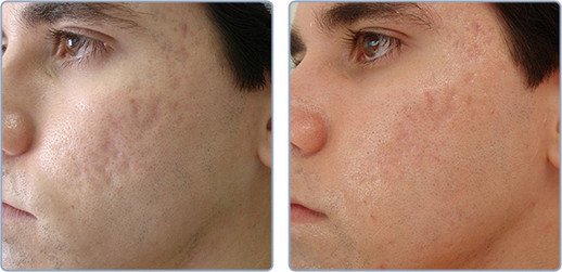 Laser stretchmark scar removal in man