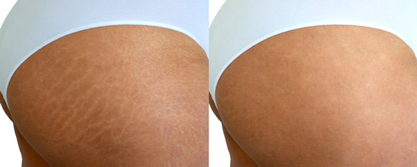 Laser stretchmark scar removal in woman