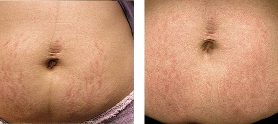 Laser stretchmark scar removal in woman