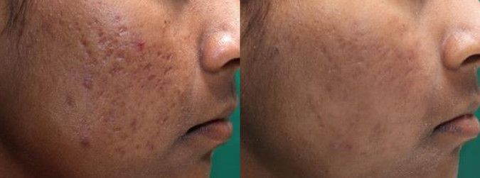 Laser stretchmark scar removal in chin