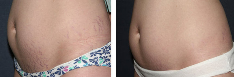 Laser stretchmark scar removal in woman