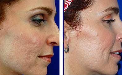 Laser stretchmark scar removal in woman