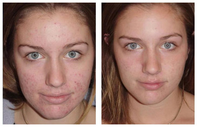 Laser stretchmark scar removal in woman