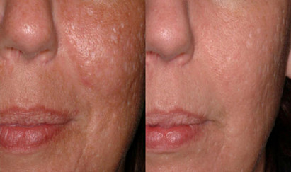 Laser stretchmark scar removal in woman