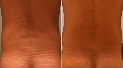 Laser stretchmark scar removal in back