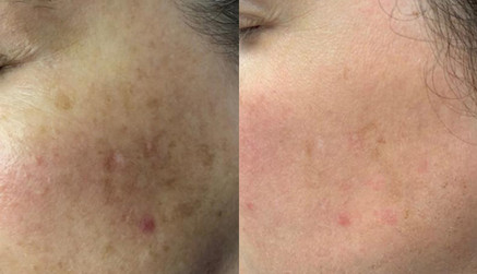 Laser stretchmark scar removal in woman
