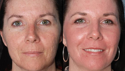 Laser stretchmark scar removal in woman