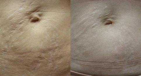 Laser stretchmark scar removal in woman