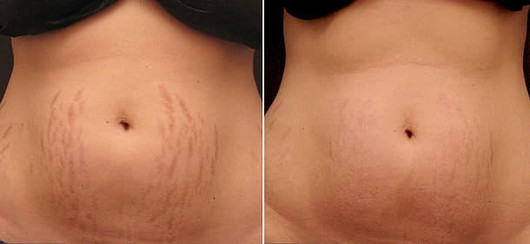 Laser stretchmark scar removal in woman