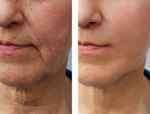Microneedling results woman
