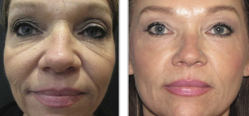 Microneedling results woman