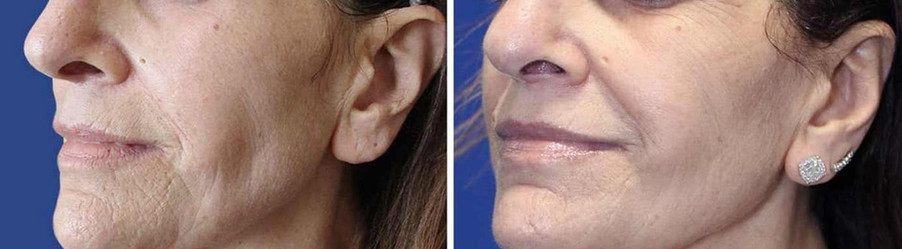 Microneedling results woman