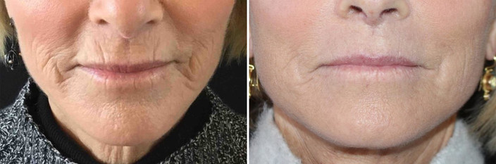 Microneedling results woman
