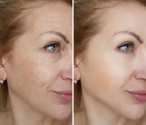 Microneedling results woman