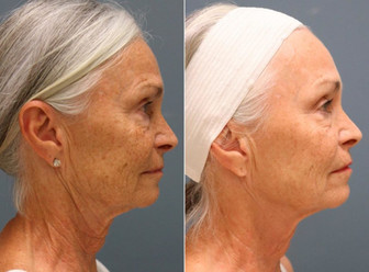 Microneedling results woman
