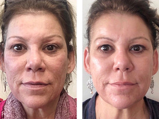 Microneedling results woman