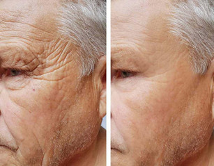 Microneedling results man