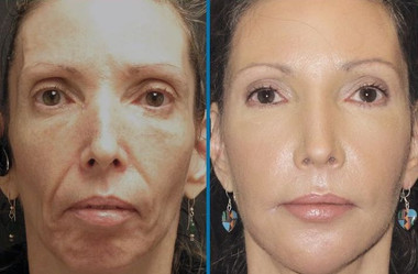 Microneedling results woman