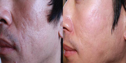 Microneedling results man