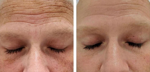 Microneedling results woman