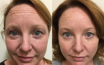 Microneedling results woman