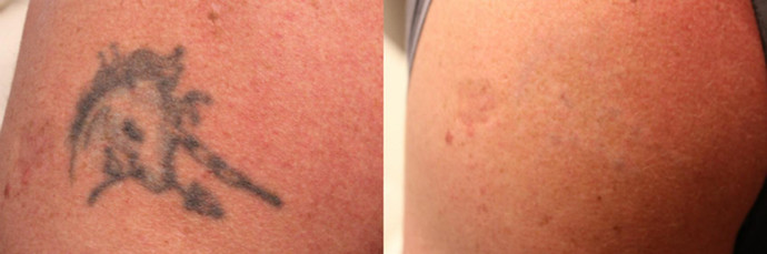 Tattoo removal results