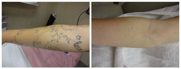 Tattoo removal in forearm