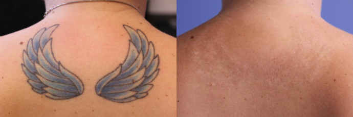 Tattoo removal in upper back